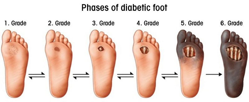 diabetic foot stages