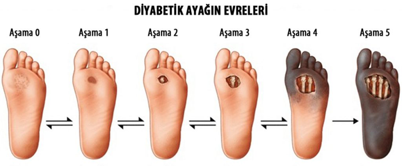 Diyabetik Ayak Evreleri