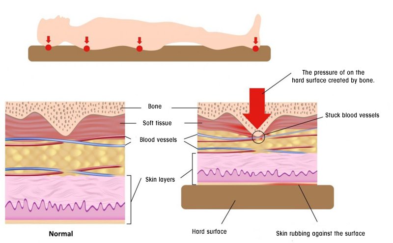 Pressure Sore and Causes