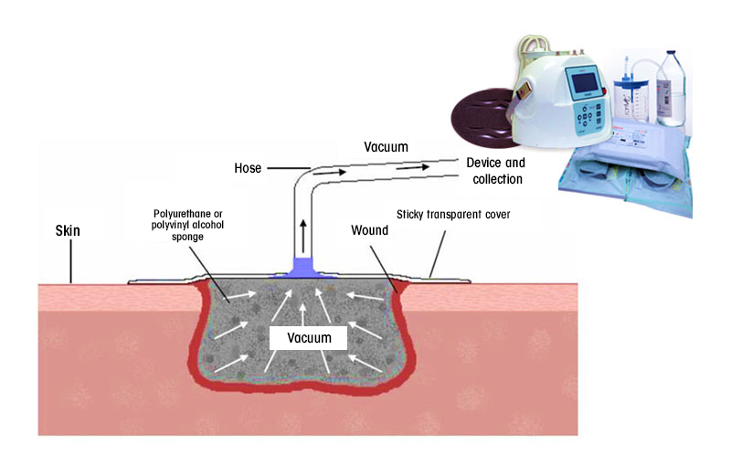 Vac Wound Treatment