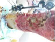 Traumatic Wound Fixator After Traffic Accident - Before