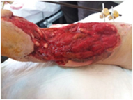 Traumatic Wound Fixator After Traffic Accident - Later