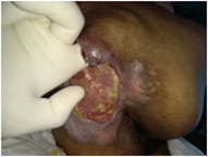 Infected Tunneled Pressure Sore - Before