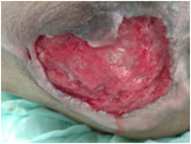 Infected Tunneled Pressure Sore