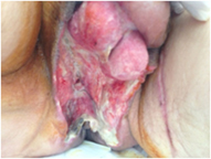 Penis and Testicle Infected Traumatic Wound - After