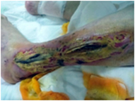Infected Venous Stasis Ulcerated Foot Wound - Before