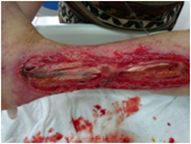 Infected Venous Stasis Ulcerated Foot Wound