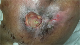 Infected bed pressure wound with necrosis after treatment, granilization tissue formation with topivac - After