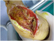 knee trauma implant fracture wound - Before