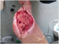 Post-treatment knee trauma implant fracture wound healing - Later