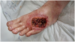 diabetic foot: infection and necrotic sugar wound, debrided wound - Before