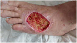 diabetic foot: infection and necrotic sugar wound, granulation of debrided wound, wound healing - Later