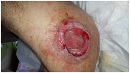 Post-Treatment Knee trauma, implant fracture wound granulation - After