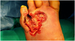 diabetic foot wound - Before