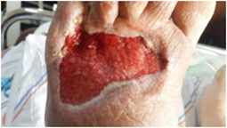 Post-treatment diabetic foot wound, granulation formation, wound healing - Later