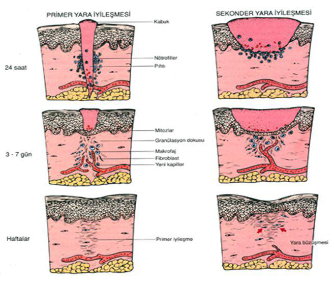 Yara İyileşmesi